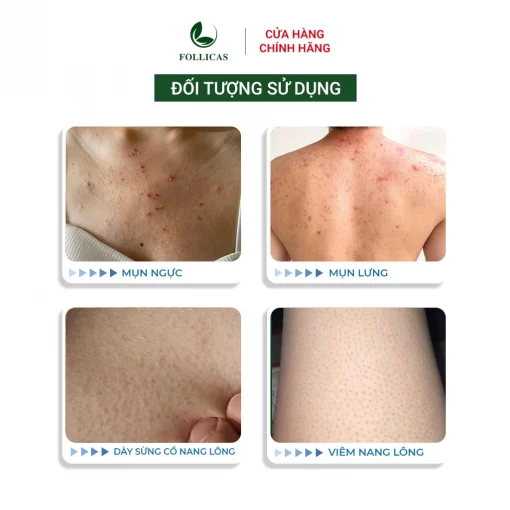 [Combo 2] Kem+Xịt Viêm Nang Lông Follicas - Hình ảnh 2