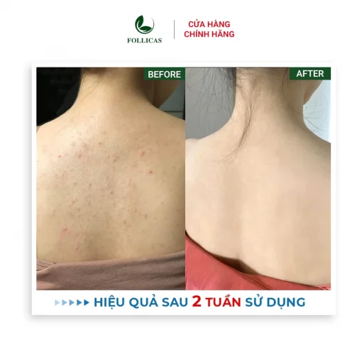 [Combo 2] Kem+Xịt Viêm Nang Lông Follicas - Hình ảnh 9